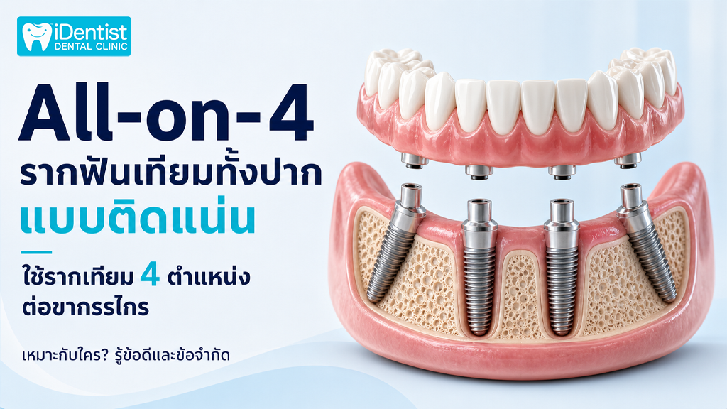 All-on-4 รากฟันเทียมทั้งปาก